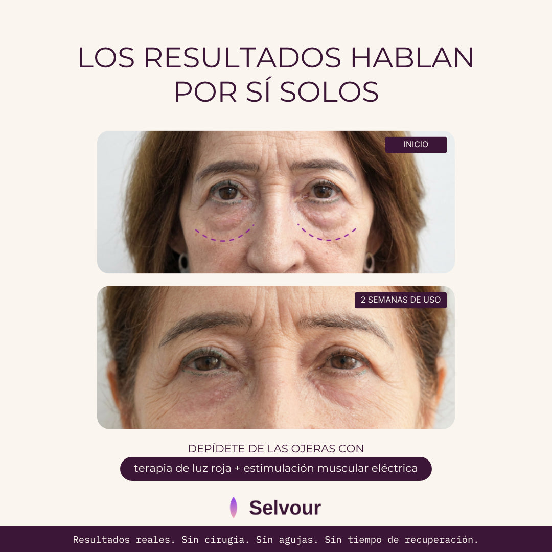 ORAYA™ | Elimina las ojeras con luz roja