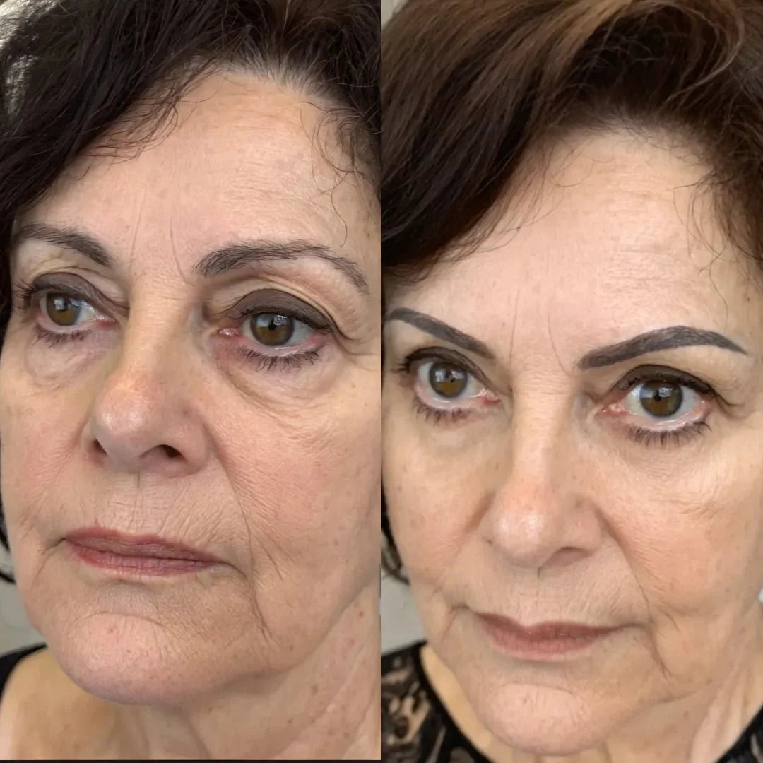 ORAYA™ | Elimina las ojeras con luz roja